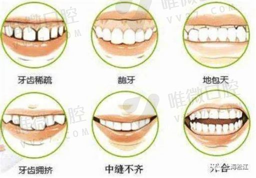 镶牙与种牙哪个好（日本人为什么不建议种植牙）(图1)